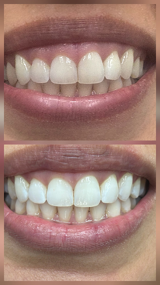 whitening before & after